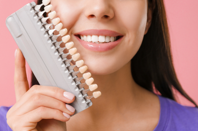 veneers